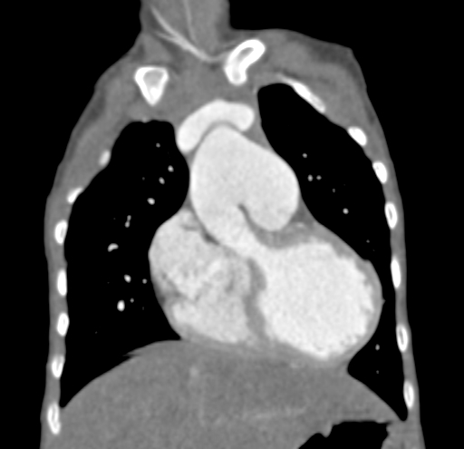 File:Aortopulmonary window, interrupted aortic arch and large PDA giving the descending aorta (Radiopaedia 35573-37074 D 19).jpg