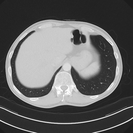 Apical pleural calcification (Radiopaedia 46141-50499 Axial lung window 62).png