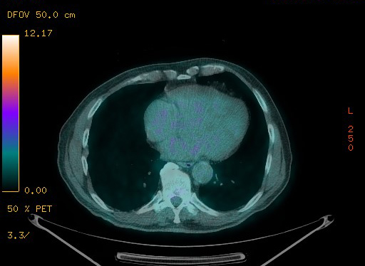 Appendiceal adenocarcinoma complicated by retroperitoneal abscess (Radiopaedia 58007-65041 Axial PET-CT 84).jpg