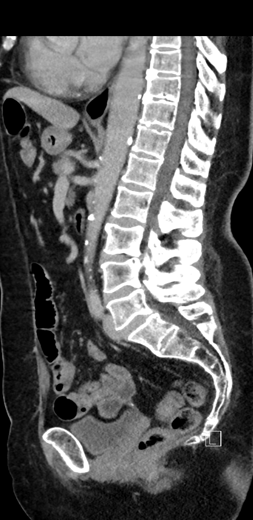 Appendiceal hemorrhage (Radiopaedia 70830-81025 Sagittal C+ delayed 60).jpg