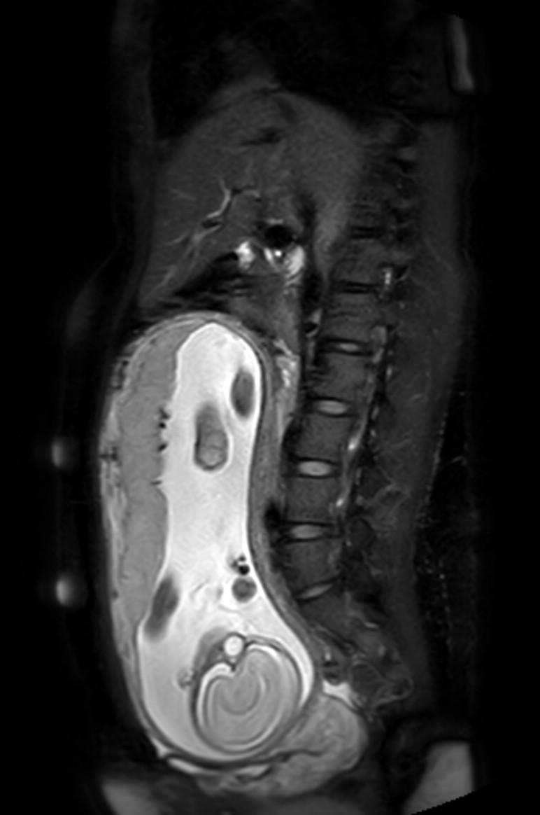Appendicitis in gravida (MRI) (Radiopaedia 89433-106395 Sagittal T2 SPAIR 34).jpg