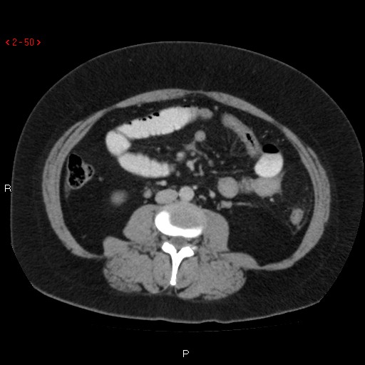 File:Appendicitis with microperforation- promontoric type (Radiopaedia 27268-27442 C 38).jpg