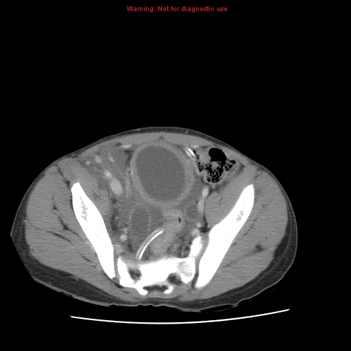 File:Appendicitis with phlegmon (Radiopaedia 9358-10046 A 58).jpg