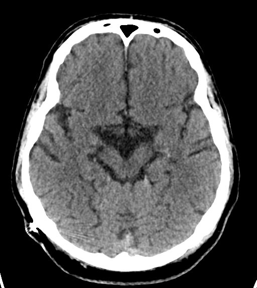 File:Aqueduct stenosis with corpus callosum hypoattenuation post shunting (Radiopaedia 37212-38971 Axial non-contrast 11).png