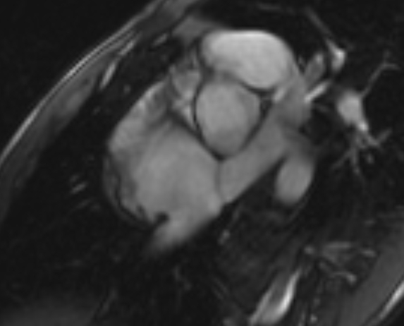 Arrhythmogenic right ventricular cardiomyopathy (Radiopaedia 69564-79464 short axis cine 285).jpg