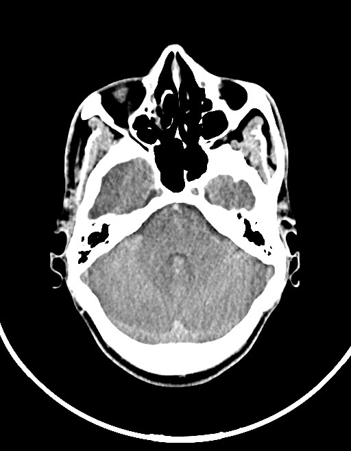 Arrow injury to the brain (Radiopaedia 72101-82607 Axial non-contrast 59).jpg