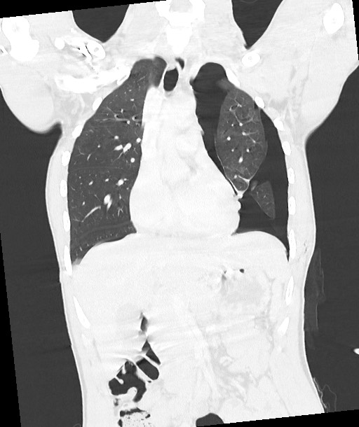 Arrow injury to the chest (Radiopaedia 85367-100975 Coronal lung window 67).jpg