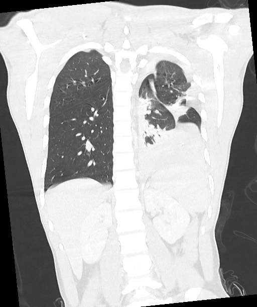 Arrow injury to the chest (Radiopaedia 85367-100975 Coronal lung window 94).jpg