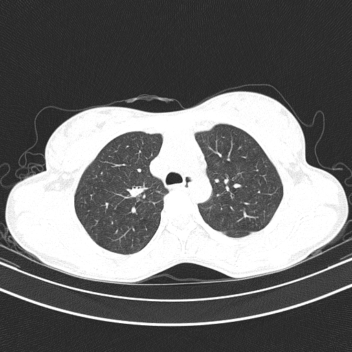 Arteria lusoria (Radiopaedia 88528-105192 Axial lung window 21).jpg