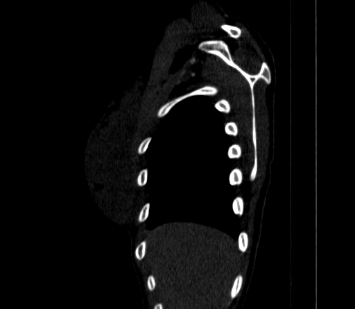 File:Arteria lusoria (Radiopaedia 88528-105192 C 19).jpg