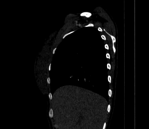File:Arteria lusoria (Radiopaedia 88528-105192 C 26).jpg