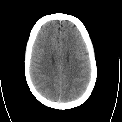 File:Arteriovenous malformation (cerebral) (Radiopaedia 40070-42579 Axial non-contrast 22).png