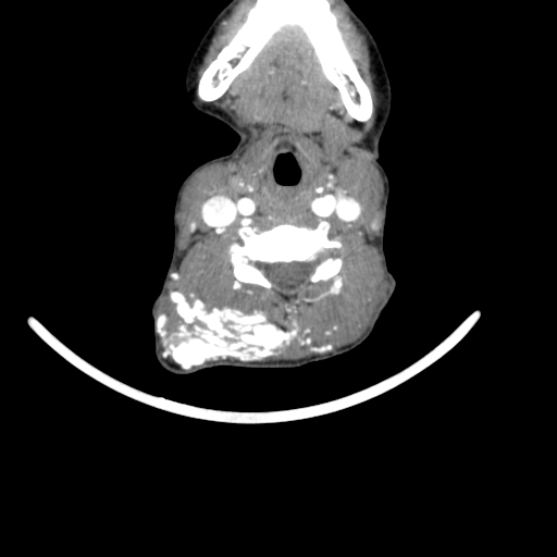 Arteriovenous malformation of the neck (Radiopaedia 53935-60062 A 27).jpg