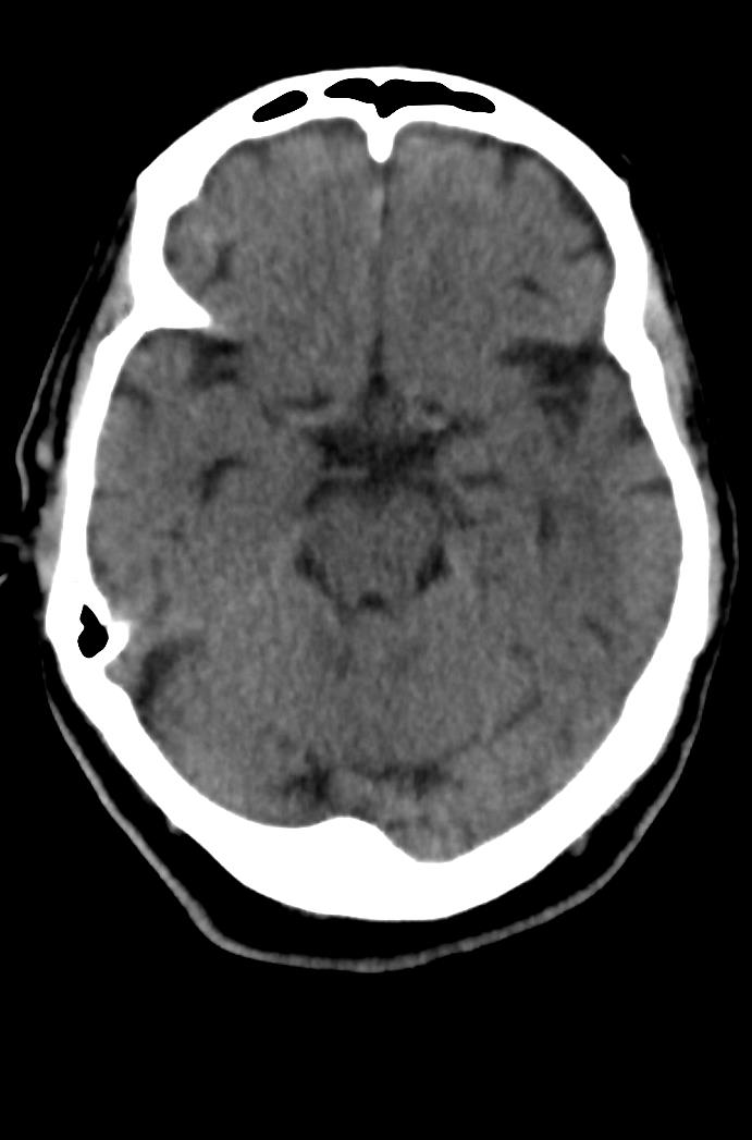 Artery of Percheron infarction (Radiopaedia 80613-94202 Axial non-contrast 73).jpg