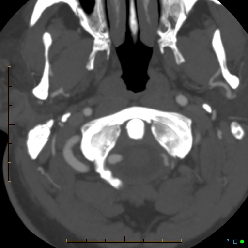 File:Artifactual basilar artery stenosis due to metallic stent (Radiopaedia 31206-31923 A 1).jpg