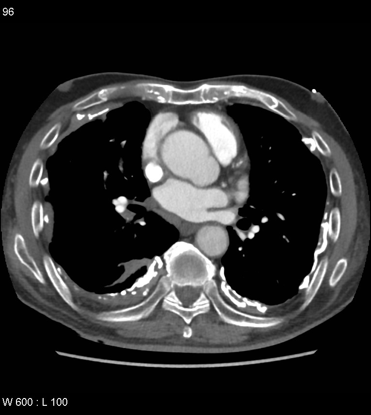 Asbestos related lung and pleural disease (Radiopaedia 14377-14301 D 32).jpg