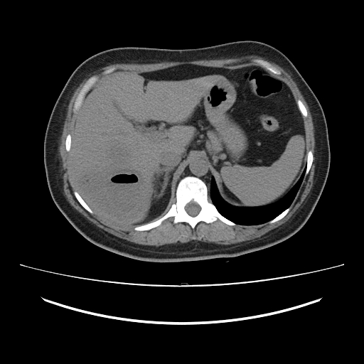 Ascending retrocecal appendicitis with liver abscesses (Radiopaedia 60066-67615 Axial non-contrast 22).jpg