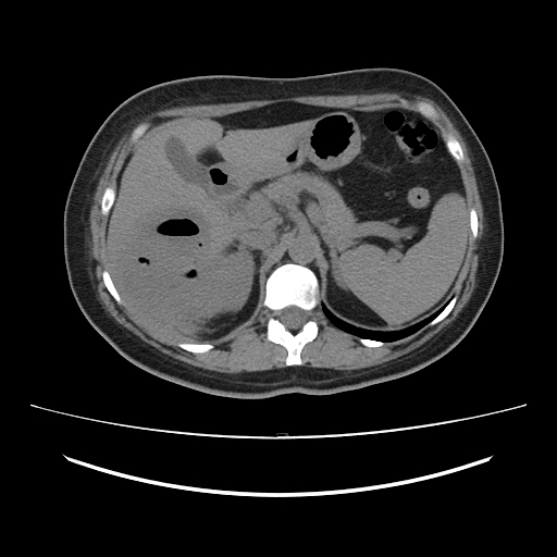 Ascending retrocecal appendicitis with liver abscesses (Radiopaedia 60066-67615 Axial non-contrast 25).jpg