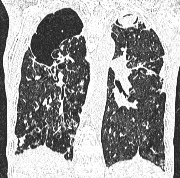 Aspergilloma- with Monod sign (Radiopaedia 44737-48532 Coronal lung window 296).jpg