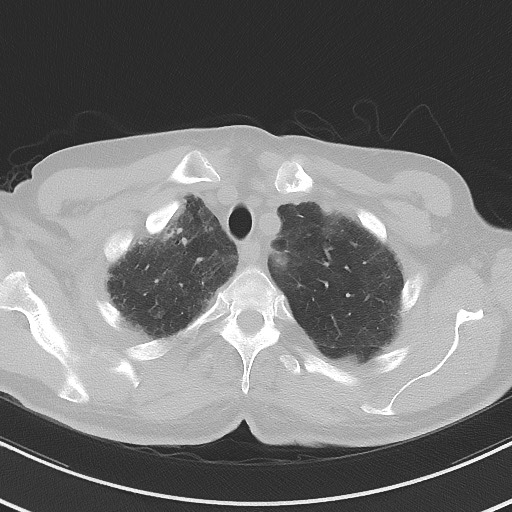File:Aspergilloma on background pulmonary fibrosis (Radiopaedia 60942-68757 A 11).jpg