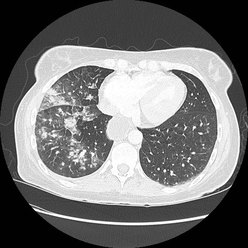 File:Aspiration pneumonia secondary to laparoscopic banding (Radiopaedia 18345-18183 lung window 81).jpg