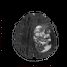 Astroblastoma (Radiopaedia 74287-85162 Axial ADC 43).jpg