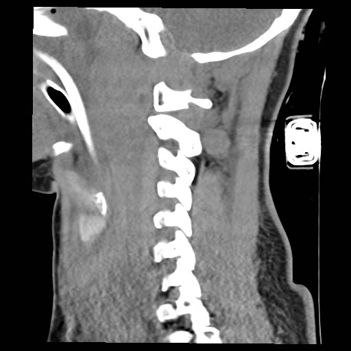 File:Atlanto-occipital dislocation (Radiopaedia 44648-48412 A 19).jpg