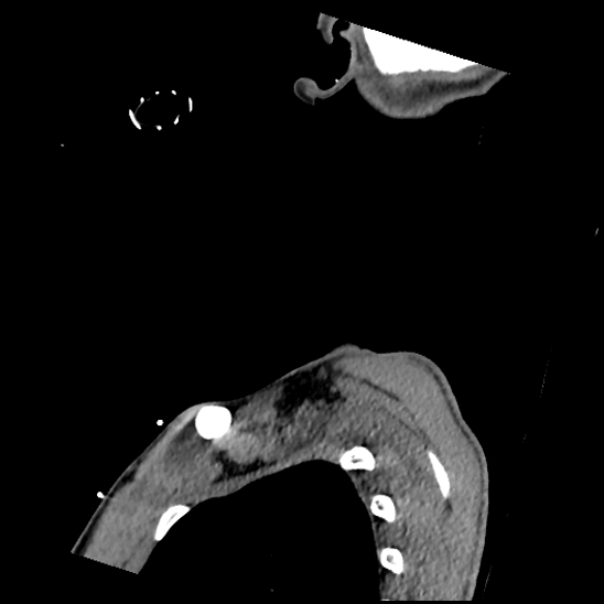 File:Atlanto-occipital dissociation (Traynelis type 1), C2 teardrop fracture, C6-7 facet joint dislocation (Radiopaedia 87655-104061 D 80).jpg