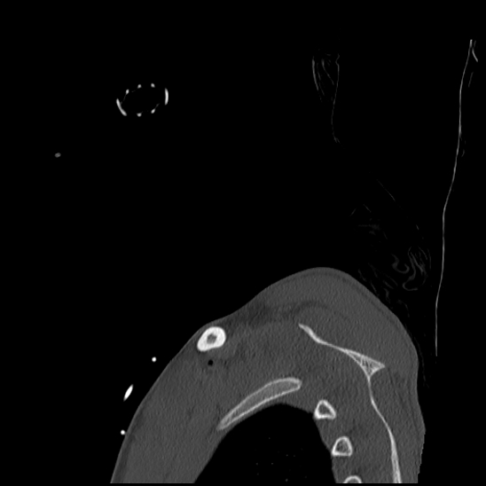 Atlanto-occipital dissociation (Traynelis type 1), C2 teardrop fracture, C6-7 facet joint dislocation (Radiopaedia 87655-104061 Sagittal bone window 80).jpg