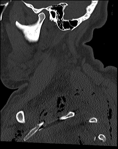 Atlanto-occipital dissociation - Traynelis type 1 (Radiopaedia 87570-103948 Sagittal bone window 21).jpg