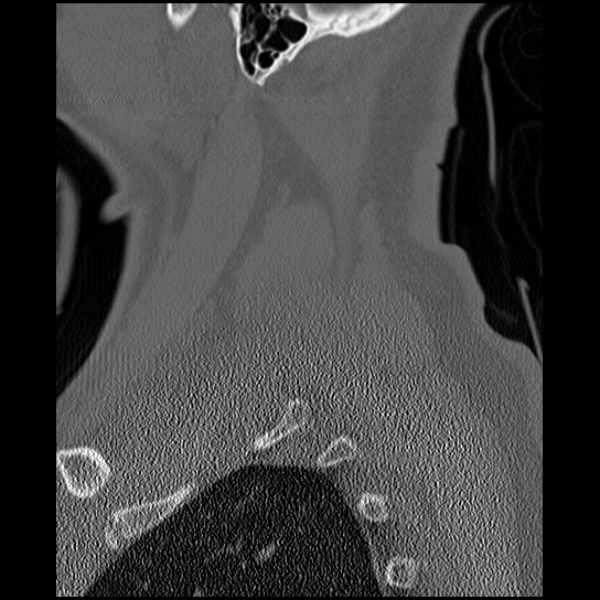 Atlanto-occipital dissociation injury (Radiopaedia 29274-29698 Sagittal bone window 54).png