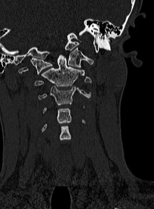 Atlantoaxial subluxation (Radiopaedia 44681-48450 Coronal bone window 32).jpg
