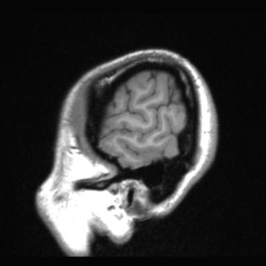 Atretic encephalocoele with inferior vermis hypoplasia (Radiopaedia 30443-31108 Sagittal T1 123).jpg