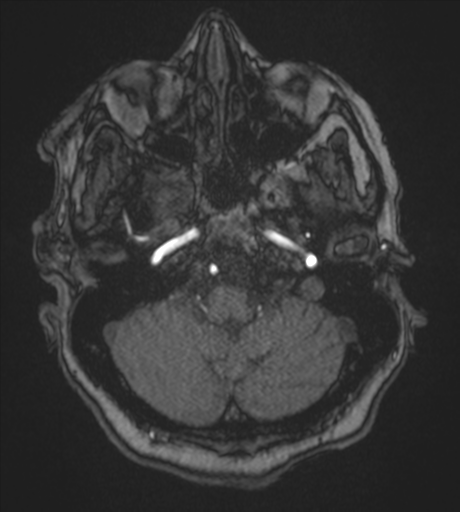 Atypical meningioma (WHO Grade II) (Radiopaedia 54742-60981 Axial MRA 19).png