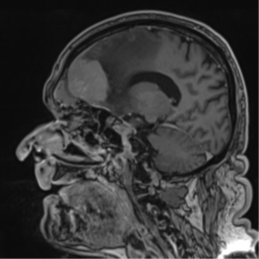 Atypical meningioma (WHO grade II) with brain invasion (Radiopaedia 57767-64729 Sagittal T1 C+ 41).png