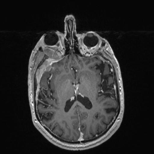 Atypical meningioma (grade II) - en plaque (Radiopaedia 29633-30147 Axial T1 C+ 105).jpg