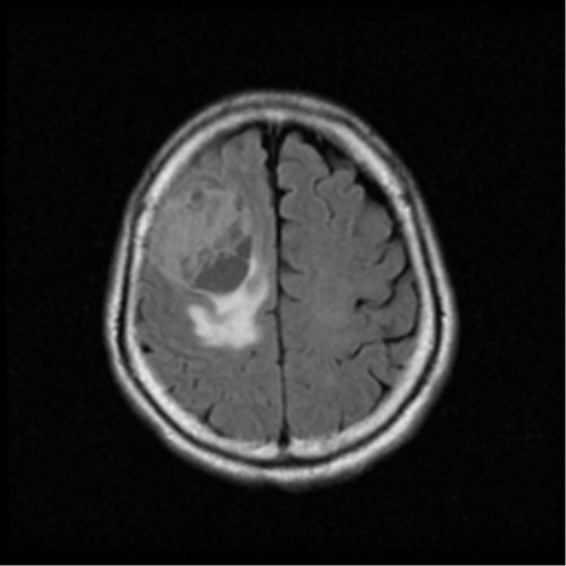 File:Atypical meningioma with skull invasion (Radiopaedia 34357-35648 Axial FLAIR 17).png