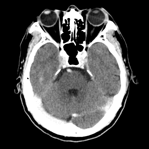 Atypical meningioma with skull invasion (Radiopaedia 34357-35649 Axial C+ delayed 18).png
