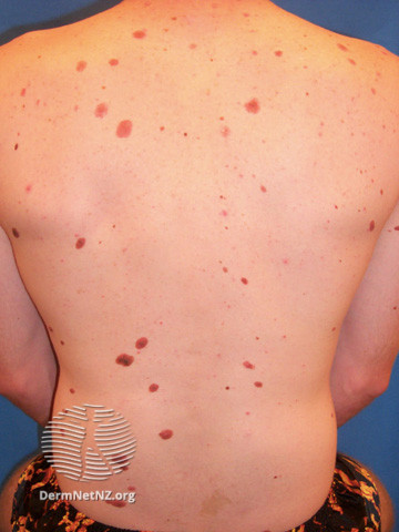 File:Atypical naevi (DermNet NZ lesions-atypical-naevi-592).jpg