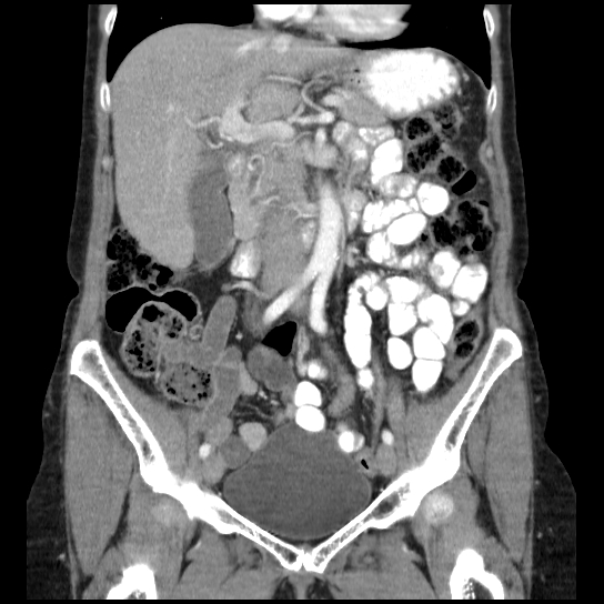 File:Atypical renal cyst (Radiopaedia 17536-17251 C 23).jpg