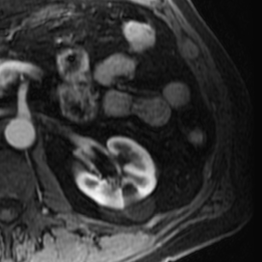 File:Atypical renal cyst on MRI (Radiopaedia 17349-17046 C 14).jpg
