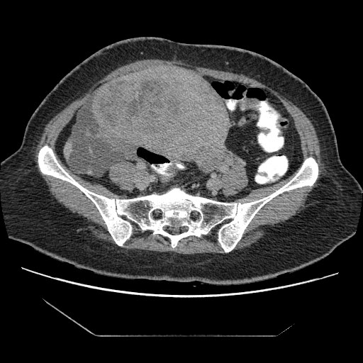 File:Atypical retroperitoneal lymphocoeles with large leiomyoma of uterus (Radiopaedia 32084-33024 A 27).jpg