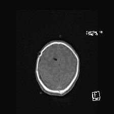 Atypical teratoid rhabdoid tumor (prenatal US and neonatal MRI) (Radiopaedia 59091-66388 Axial T1 48).jpg
