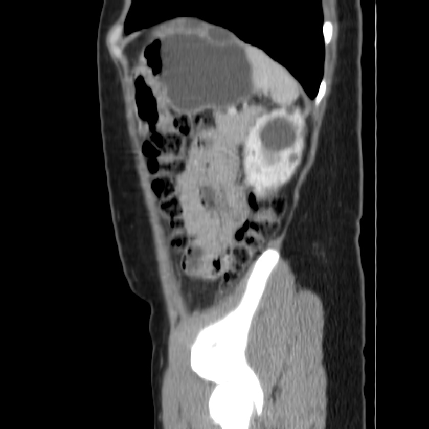 Autosomal dominant polycystic kidney disease (Radiopaedia 23061-23093 F 46).jpg