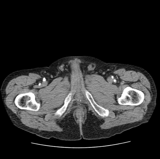 Autosomal dominant polycystic kidney disease (Radiopaedia 27851-28094 B 128).jpg
