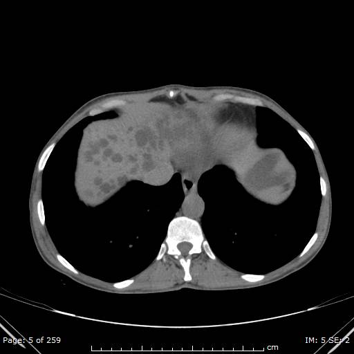 Autosomal dominant polycystic kidney disease (Radiopaedia 44122-47684 Axial non-contrast 2).jpg
