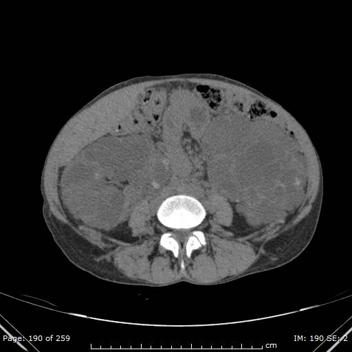 Autosomal dominant polycystic kidney disease (Radiopaedia 44122-47684 Axial non-contrast 68).jpg