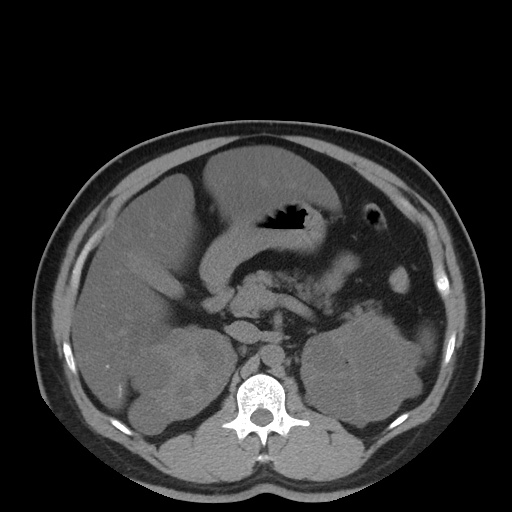 Autosomal dominant polycystic kidney disease (Radiopaedia 50259-55612 Axial non-contrast 32).jpg