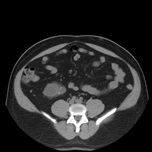 Autosomal dominant polycystic kidney disease (Radiopaedia 50259-55612 Axial non-contrast 55).jpg