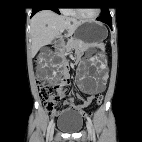Autosomal dominant polycystic kidney disease (Radiopaedia 66349-75582 A 24).jpg